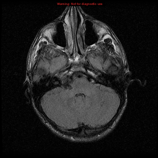 File:Neurofibromatosis type 2 (Radiopaedia 8953-9730 Axial FLAIR 8).jpg
