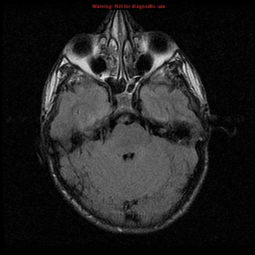 File:Neurofibromatosis type 2 (Radiopaedia 8953-9730 Axial FLAIR 9).jpg