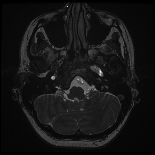 File:Neurofibromatosis type 2 - bilateral acoustic neuromata (Radiopaedia 40060-42566 Axial FIESTA 18).png