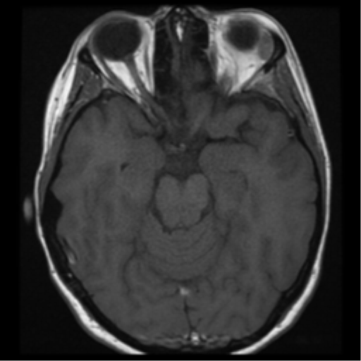 File:Neurofibromatosis type 2 - bilateral acoustic neuromata (Radiopaedia 40060-42566 Axial T1 12).png