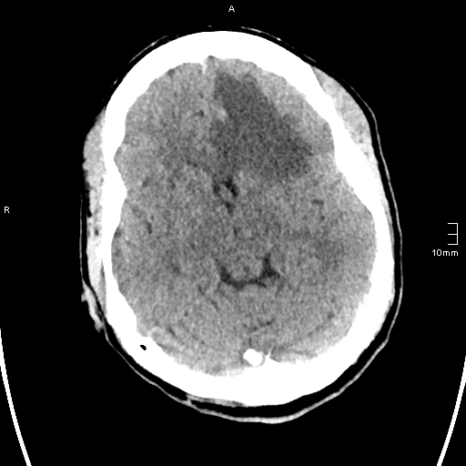 File:Neurotoxoplasmosis - concentric target sign (Radiopaedia 70644-80783 Axial non-contrast 15).jpg