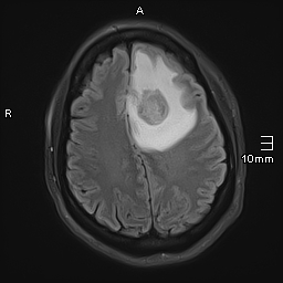 File:Neurotoxoplasmosis - concentric target sign (Radiopaedia 70644-80784 Axial FLAIR 15).jpg