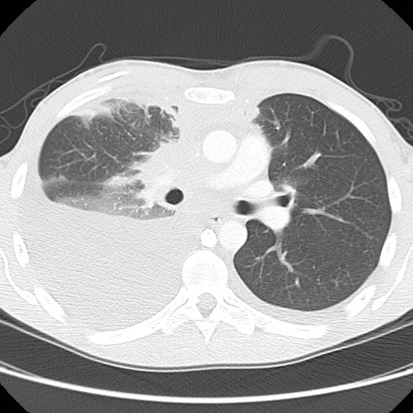 File:Non-Hodgkin lymphoma involving lung (Radiopaedia 29094-29470 Axial lung window 32).jpg