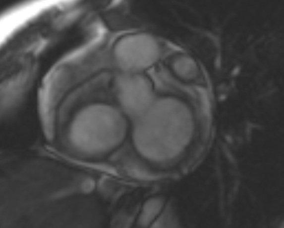 File:Non-compaction of the left ventricle (Radiopaedia 69436-79314 Short axis cine 202).jpg