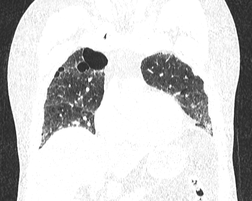 Non-specific interstitial pneumonia (NSIP) (Radiopaedia 68599-78228 Coronal lung window 28).jpg
