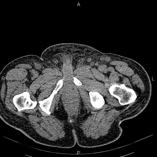 File:Non Hodgkin lymphoma in a patient with ankylosing spondylitis (Radiopaedia 84323-99621 Axial non-contrast 65).jpg