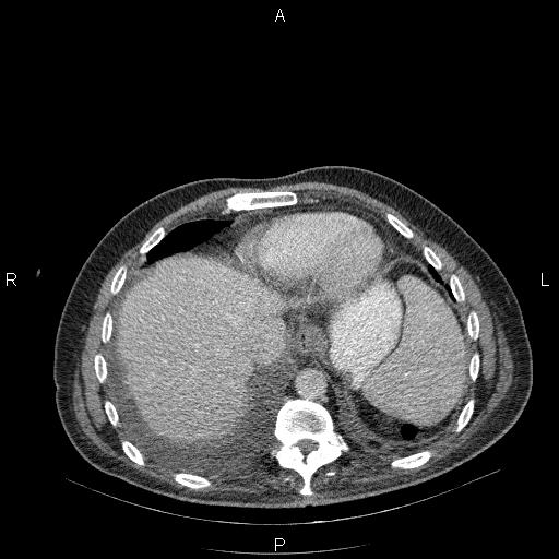 File:Non Hodgkin lymphoma in a patient with ankylosing spondylitis (Radiopaedia 84323-99624 B 24).jpg