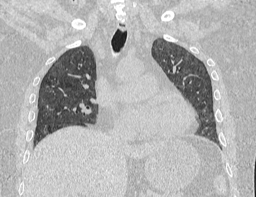 Non specific interstitial pneumonia (NSIP) (Radiopaedia 89725-106798 Coronal lung window 35).jpg