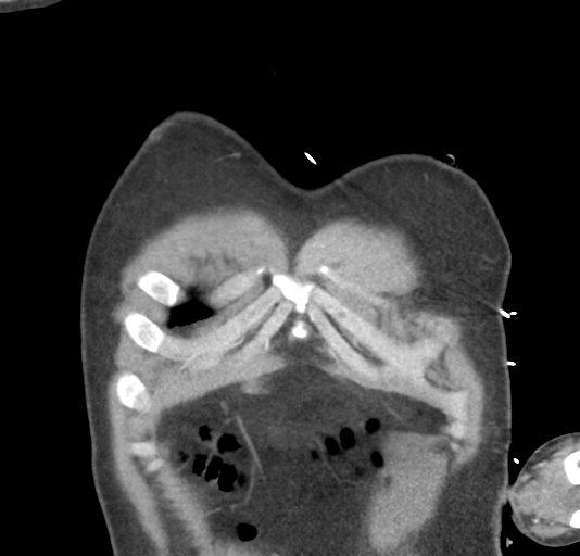 File:Normal CTA thorax (non ECG gated) (Radiopaedia 41750-44704 B 12).png
