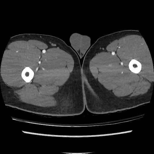 File:Normal CT angiogram of pelvis (Radiopaedia 45390-49430 A 70).jpg