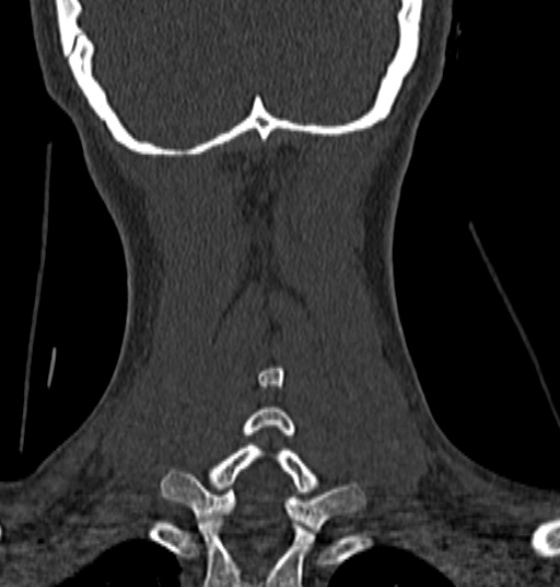 File:Normal CT cervical spine - 12-year-old (Radiopaedia 55352-61775 Coronal bone window 189).jpg