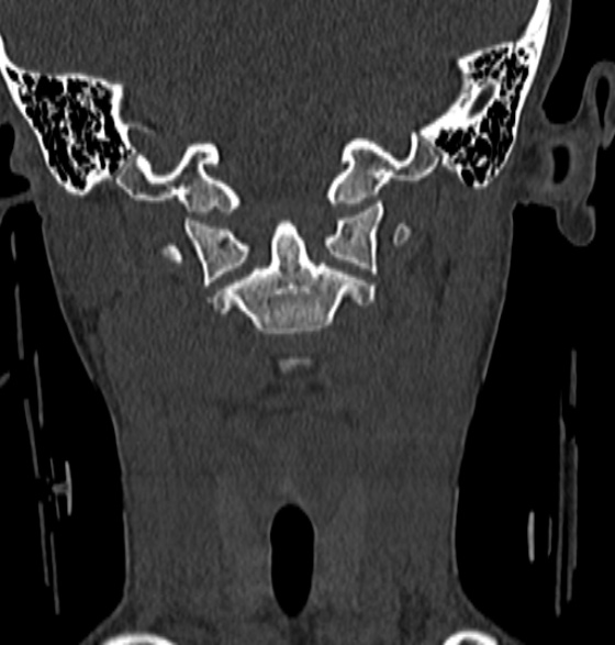 File:Normal CT cervical spine - 12-year-old (Radiopaedia 55352-61775 Coronal bone window 64).jpg