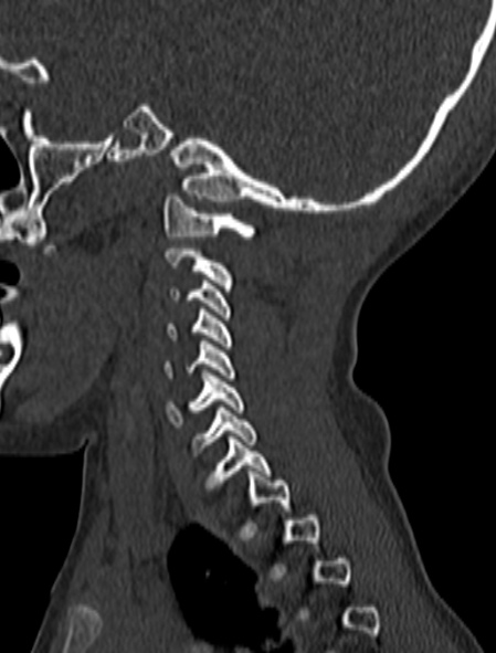 File:Normal CT cervical spine - pediatric (Radiopaedia 52549-58462 Sagittal bone window 41).jpg