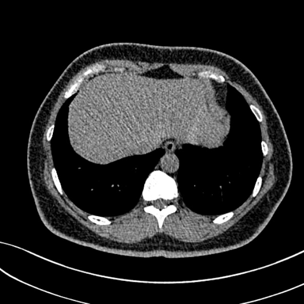Normal CT chest- adult female (Radiopaedia 52522-58428 Axial non-contrast 105).jpg