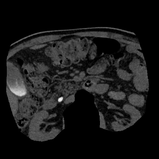 File:Normal CT intravenous cholangiogram (Radiopaedia 38199-40208 Axial IVC (MIP) 17).png