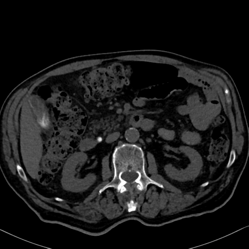 File:Normal CT intravenous cholangiogram (Radiopaedia 38199-40208 Axial IVC 49).png
