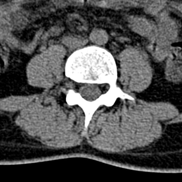 Normal CT lumbar spine (Radiopaedia 53981-60118 Axial non-contrast 65).jpg