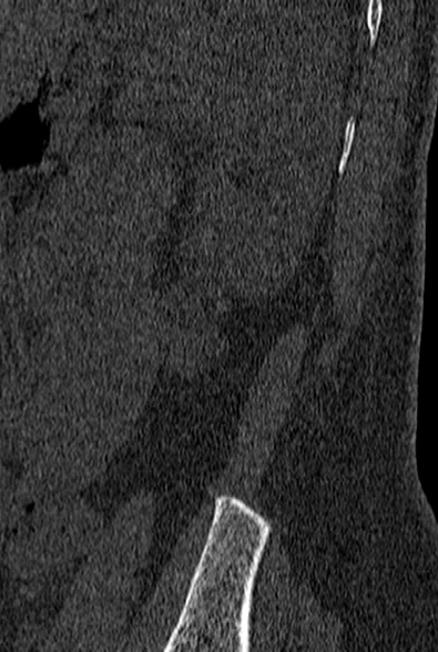 File:Normal CT lumbar spine (Radiopaedia 53981-60118 Sagittal bone window 100).jpg