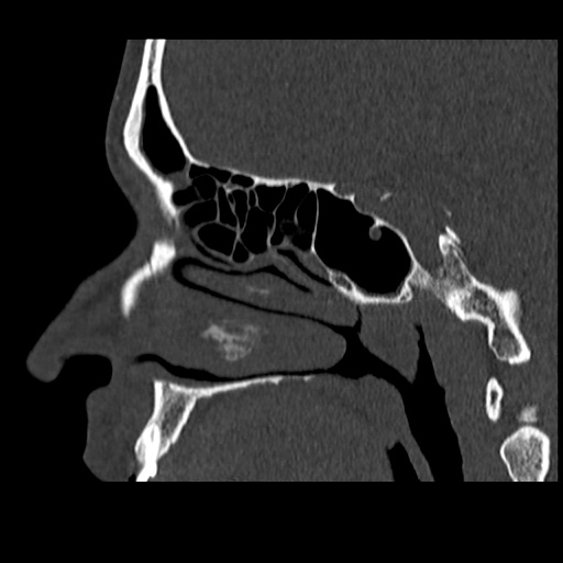 Normal CT paranasal sinuses (Radiopaedia 42286-45390 Sagittal bone window 61).jpg