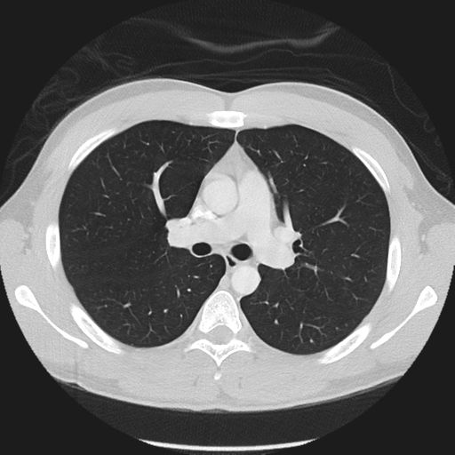 Normal CT pulmonary veins (pre RF ablation) (Radiopaedia 41748-44702 Axial lung window 12).png