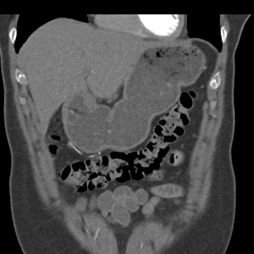 File:Normal CT renal artery angiogram (Radiopaedia 38727-40889 B 21).png