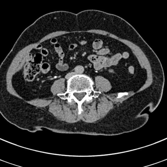 File:Normal CT split bolus study of the renal tract (Radiopaedia 48631-53634 Axial split bolus 161).jpg