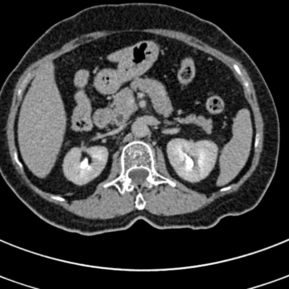 File:Normal CT split bolus study of the renal tract (Radiopaedia 48631-53634 Axial split bolus 53).jpg