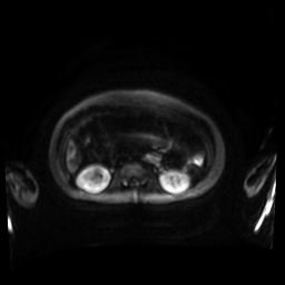 Normal MRI abdomen in pregnancy (Radiopaedia 88001-104541 Axial DWI 74).jpg