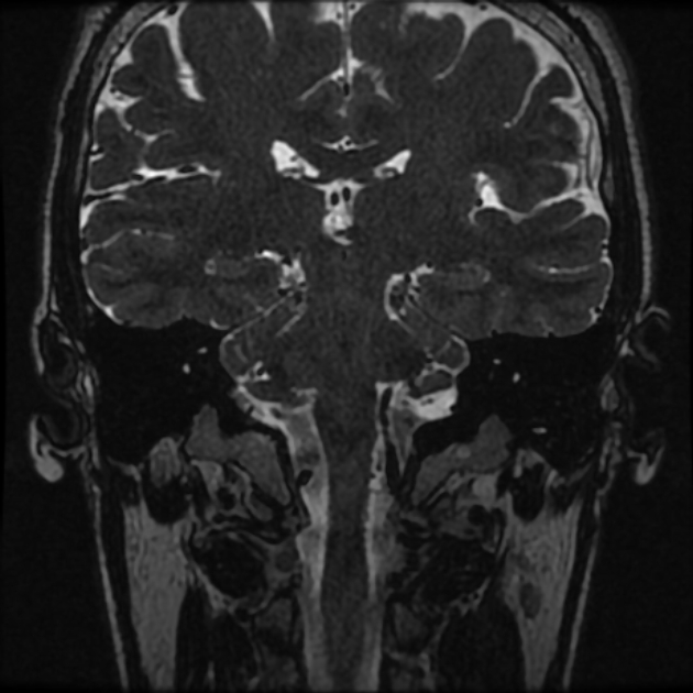 Normal MRI petrous (Radiopaedia 91317-108949 Coronal T2 64).jpg