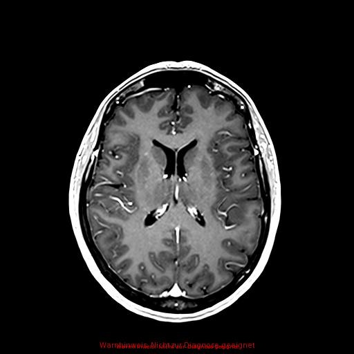 Normal adult brain MRI (non-enhanced and contrast-enhanced) (Radiopaedia 75262-86379 Axial T1 C+ 115).jpg