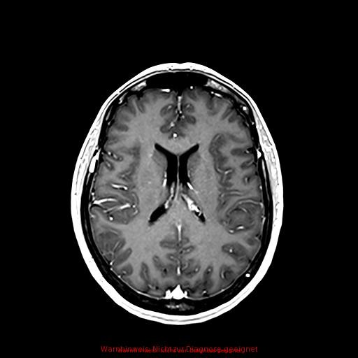 Normal adult brain MRI (non-enhanced and contrast-enhanced) (Radiopaedia 75262-86379 Axial T1 C+ 118).jpg