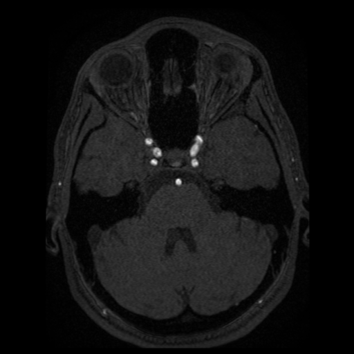 Normal brain MRA (Radiopaedia 41046-43793 Axial MRA 77).png