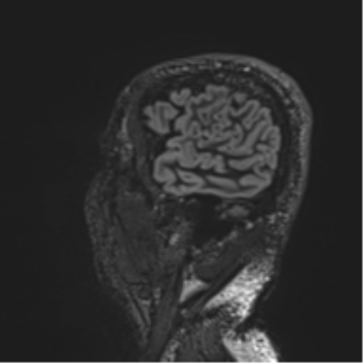 Normal brain MRI (non-focal epilepsy protocol) (Radiopaedia 53917-60040 Sagittal DIR 53).png