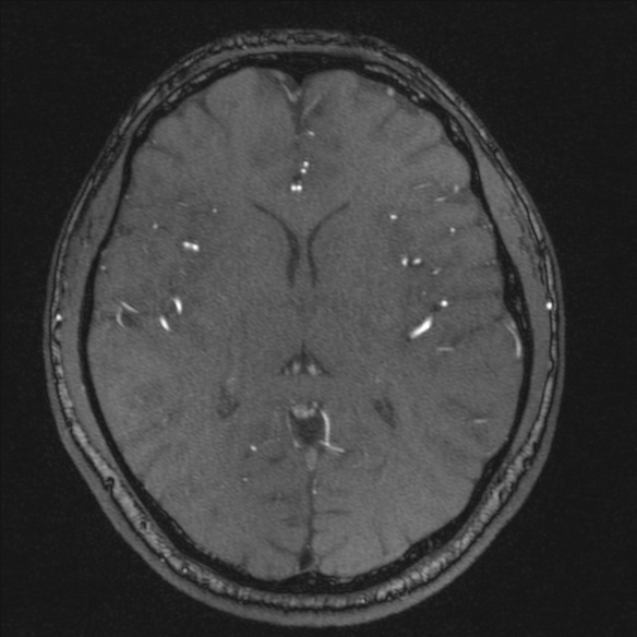 Normal brain MRI including MRA (Radiopaedia 48748-53763 Axial MRA 118).jpg