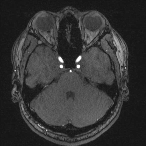 Normal brain MRI including MRA (Radiopaedia 48748-53763 Axial MRA 58).jpg