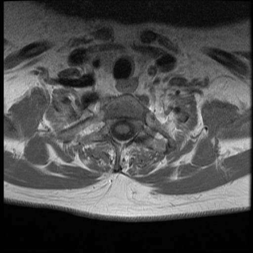 File:Normal cervical and thoracic spine MRI (Radiopaedia 35630-37156 Axial T1 C+ 6).png
