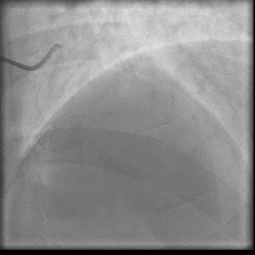 Normal coronary angiogram (DSA) (Radiopaedia 63081-71571 E 12).jpg