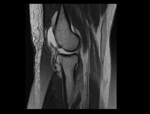 File:Normal elbow arthrograms (Radiopaedia 75550-86805 Sagittal PD 16).jpg