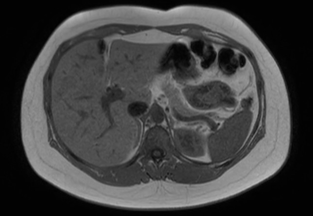 File:Normal liver MRI with Gadolinium (Radiopaedia 58913-66163 Axial T1 in-phase 21).jpg