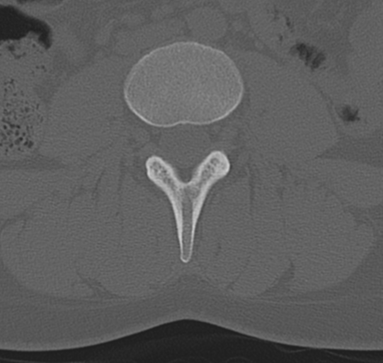 File:Normal lumbar spine CT (Radiopaedia 46533-50986 Axial bone window 39).png