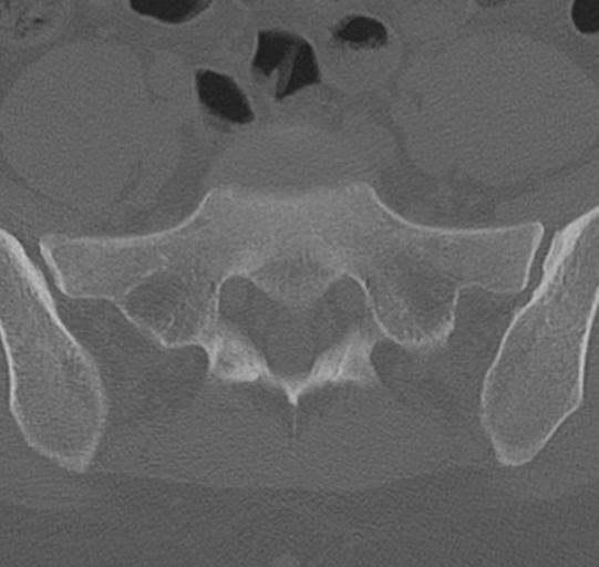 File:Normal lumbar spine CT (Radiopaedia 46533-50986 Axial bone window 68).png