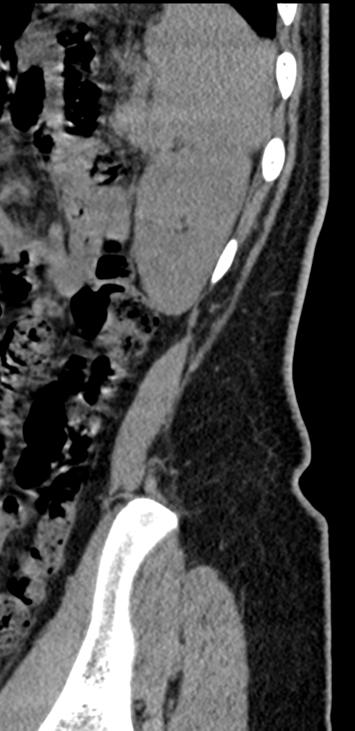 Normal lumbosacral CT (Radiopaedia 37923-39867 E 8).png