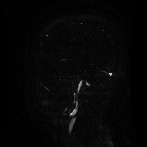 Normal noncontrast MR venography (Radiopaedia 87578-103957 A 127).jpg