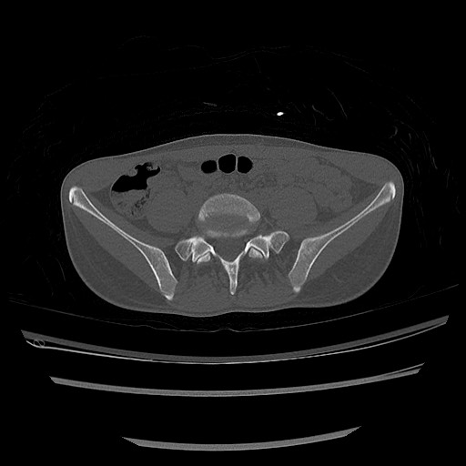 Normal pelvis CT (Radiopaedia 51471-57236 Axial bone window 17).jpg