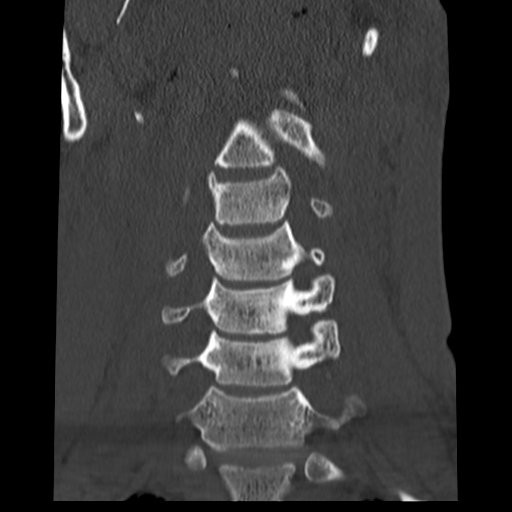 File:Normal trauma cervical spine (Radiopaedia 41017-43760 Coronal bone window 12).png