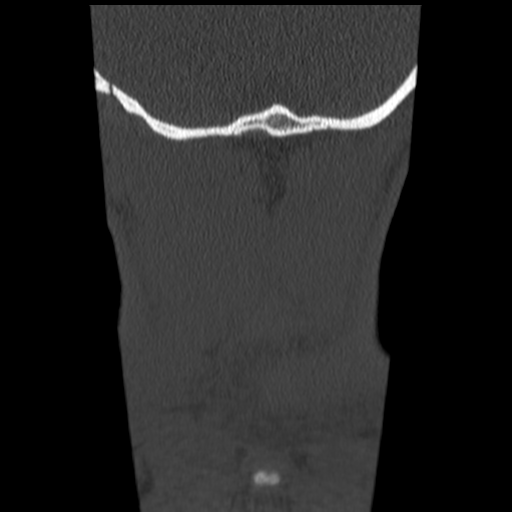 File:Normal trauma cervical spine (Radiopaedia 41017-43760 Coronal bone window 51).png