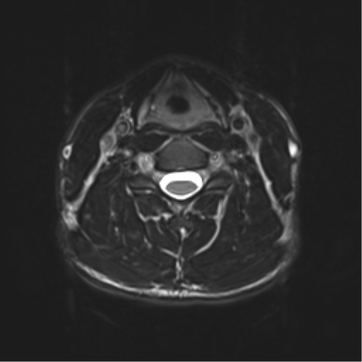 Normal trauma cervical spine (Radiopaedia 41017-43762 D 28).png
