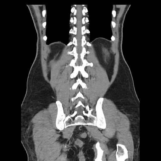 File:Obstructed kidney with perinephric urinoma (Radiopaedia 26889-27067 Coronal non-contrast 27).jpg
