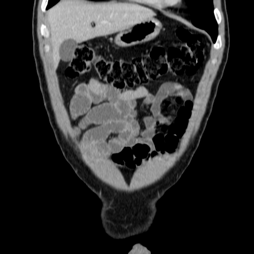 File:Obstructing ureteric calculus (Radiopaedia 18615-18514 C 13).jpg