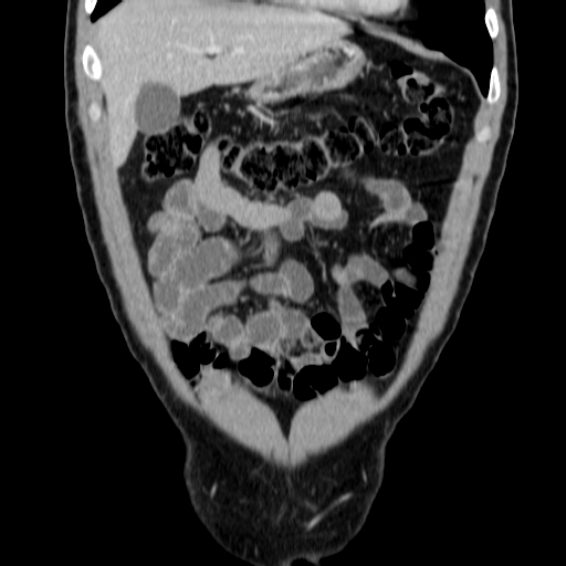 File:Obstructing ureteric calculus (Radiopaedia 18615-18514 C 16).jpg